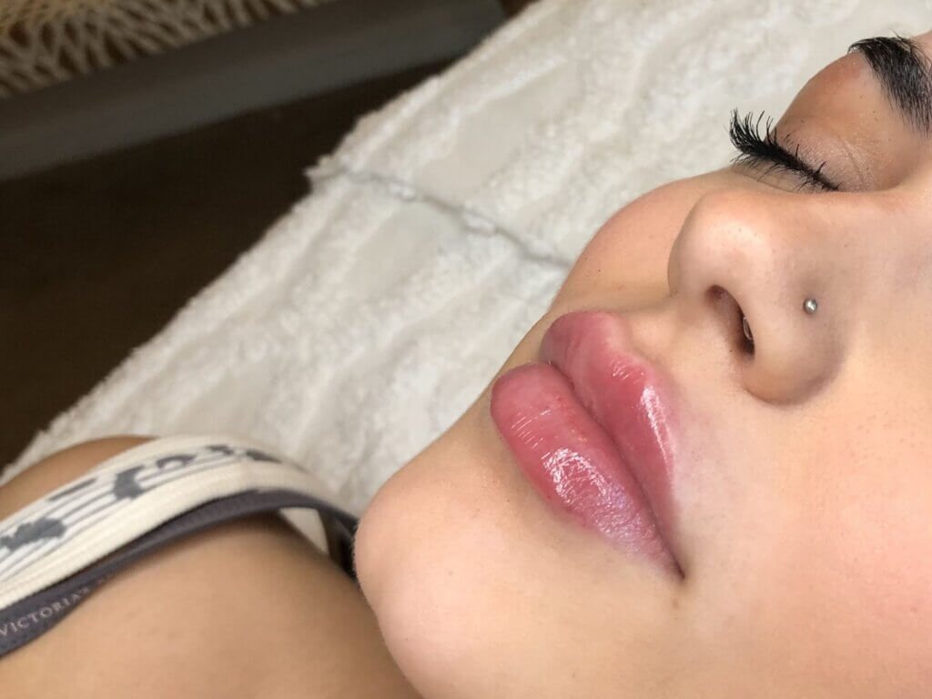 lip filler results quincy ma  Inde Salon & Skin Care  Inde Salon & Skin Care